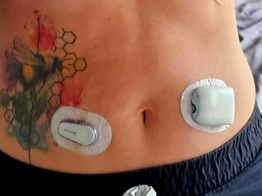 Where Can I Wear Omnipod 5 and My CGM Together?